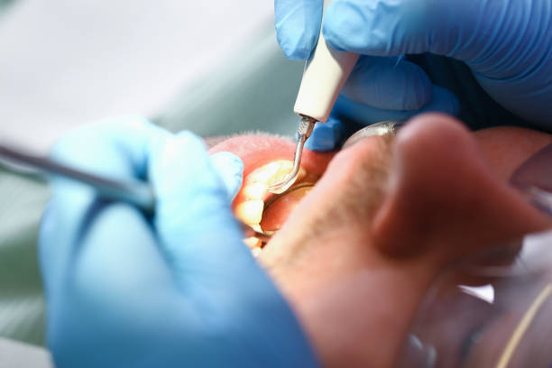 Best Emergency Dental Care for Abscessed Tooth in Canyon Lake, TX